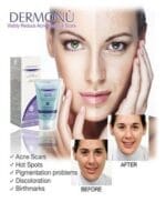 Dermonu Acne Remover Gel – Clear Skin, Confidence Restored - Image 2
